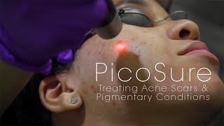 PicoSure Laser for Acne Scars amp Pigmentation [upl. by Wexler]