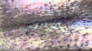 Pediculosis pthyris  body louse [upl. by Adnilra876]