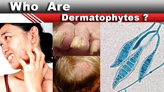 Who are dermatophytes [upl. by Licht]