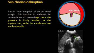 Ultrasound Imaging of Placental Abruption [upl. by Eerolam]