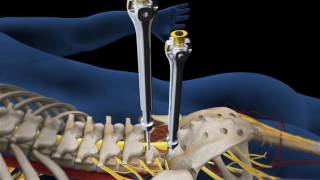 Lumbar Fusion of L5 S1 Animation [upl. by Eliam301]