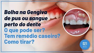 Bolha na Gengiva de pus ou sangue perto do dente O que pode ser Tem remédio caseiro Como tirar [upl. by Enymsaj]