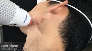 Testimonial amp Demo  NeoClear Acne Treatment on Asian Skin [upl. by Riane]