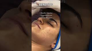 Effective Organic Peel to Remove Active Acne  Asian Roots  Delhi  Gurgaon  Kolkata [upl. by Vittorio320]