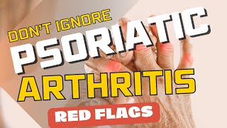 5 Signs you may be at risk for psoriatic arthritis [upl. by Armelda152]