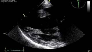 3 RUPTURE CHORDAE TRANSGASTRIC TOE VIEW MITRAL REGURGITATION [upl. by Guntar]