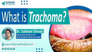 Symptoms amp Causes of Trachoma  Treatments and Stages of Trachoma  Shekar Eye Hospital Bangalore [upl. by Fredia]