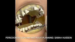 periodontal scaling and root planning by sarah hussein [upl. by Sirromad43]