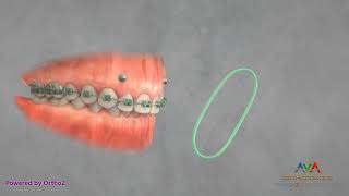 Orthodontic Treatment for Gummy Smile  TAD and Elastics [upl. by Olin]