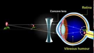 what is myopia Short Sightedness [upl. by Osrock]