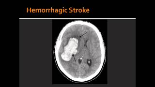 Atherosclerosis Hemorrhagic Stroke Ischemic Stroke amp Transient Ischemic Attack TIA [upl. by Oliana835]