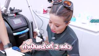 รอยสักแบบไหนก็ลบได้ ไม่ทิ้งรอยแผล  โปรแกรม Picosecond Laser [upl. by Kurland551]