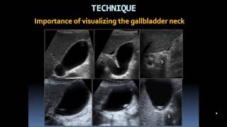 Basic Gallbladder [upl. by Elvira]