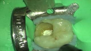 Simple Technique for PreEndodontic Restoration [upl. by Calondra434]