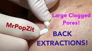 Deep clogged pores on the back extracted Blackhead removal up close by the dozens [upl. by Enimzzaj]