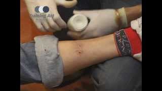 Bandaging  Pressure Immobilisation [upl. by Nohsauq]