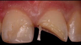 Rebuilding a Fractured Tooth with Pins [upl. by Alboran]