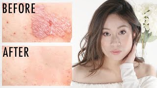 Psoriasis  How To Get Rid of Itchy Scaly Skin  Vivienne Fung [upl. by Raine]