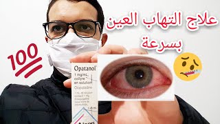 علاج التهاب ملتحمة العين الفيروسي بقطرات أوبتانول OPATANOL [upl. by Manup]