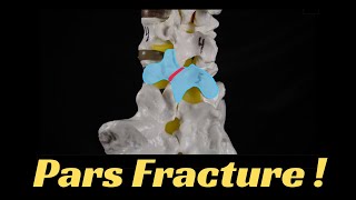 What is a pars fracture Everything you need to know [upl. by Gavriella599]