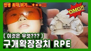 💦이건 또 뭐야💦 주걱턱 비대칭 을 위한 구개확장장치 RPE [upl. by Olodort]