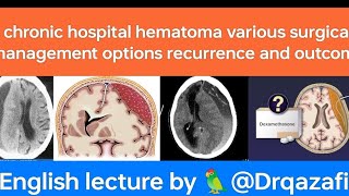 chronic subdural hematomaEnglish lecture evaluation various surgical treatment options and outcome [upl. by Eenaj]