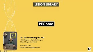 Pathology of PEComa [upl. by Ridley]