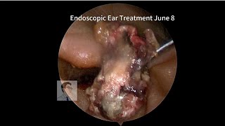 Treatment of Cholesteatoma with general anesthesia drzhao earwax earwaxremoval Cholesteatoma [upl. by Ativahs305]