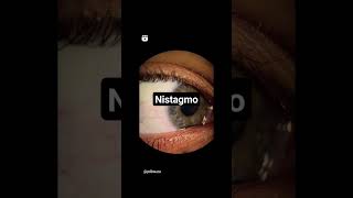 nistagmo nystagmus videonistagmografia Vestibular mareo dizzy vértigo tontura neurology [upl. by Walling901]