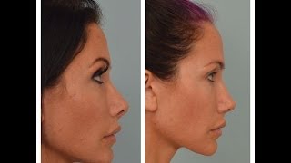 UPDATED Rhinoplasty Advice From Patient Nose Job Questions [upl. by Bernardi566]