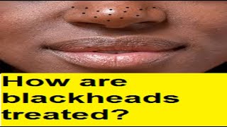 How are blackheads treated [upl. by Norina578]