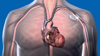 What Is a Pacemaker and How Does It Work [upl. by Atsugua]