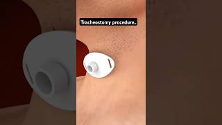 🫁tracheostomy procedure nursing🫁 youtube shorts short trending ytshorts norcetmcq trend [upl. by Veta22]