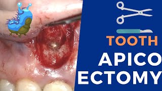 Apicoectomy surgery  Live procedure step by step [upl. by Olsewski]