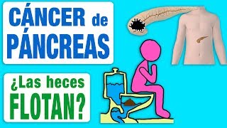 El cáncer de páncreas ¿hace flotar las heces [upl. by Campy]