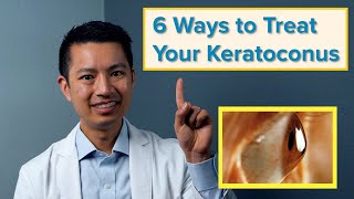 The 6 Best Ways to Treat Your Keratoconus [upl. by Dunston]