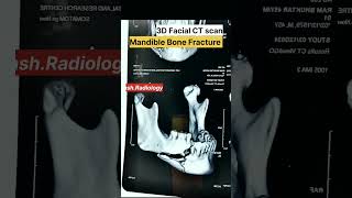 Mandible Bone Fracture 3D Face CT Scan Radiology Case shorts ctscan [upl. by Brewster998]