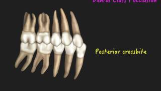 Clinical Tip Use Bite Turbos in the Correction of Posterior Crossbite｜【Chris Chang Ortho】CC431 [upl. by Ennalyrehc]