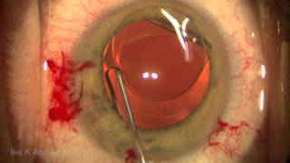 Treatment of Negative Dysphotopsia Reverse Optic Capture [upl. by Renmus589]