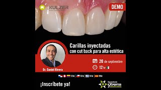 Desarrollando eXpertos  Carillas inyectadas con cut back para alta estética [upl. by Llemhar]