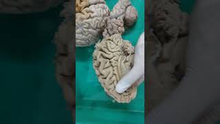 gyrus and sulcus of brain🧠MBBS 1ST YEAR ANATOMY DISSECTION⚕️ neet mbbs youtube doctor subscribe [upl. by Abel]