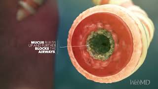 Chronic Obstructive Pulmonary Disease [upl. by Ttayw]