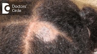 What causes Scalp Ringworm Effective Treatment   Tinea Capitis  Dr Tina Ramachander [upl. by Eerrehs]