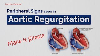 Making Bedside Diagnosis Easy Peripheral Signs in Aortic Regurgitation [upl. by Ettelegna]