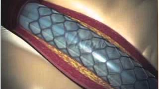 Angioplastia con Stent Parte 22  FOSCAL [upl. by Asiul68]