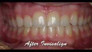 Invisalign Express with WhiteningBefore amp AfterMick Family Dental Care [upl. by Sarah334]