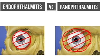 Endophthalmitis Vs Panophthalmitis Causes Diagnosis Treatment complications  Explained 👁️ [upl. by Redle]