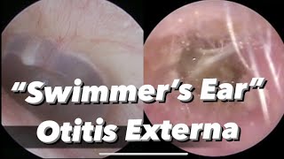 Otitis Externa  Swimmers Ear  infection of the outer ear ear canal [upl. by Nats]