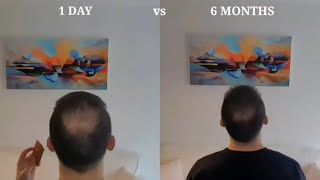 How to Derma Roll for Hair Regrow  My Half a Year Results [upl. by Floris305]