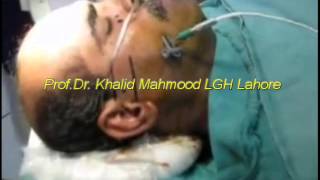 RFR for Trigeminal Neuralgia pain by Prof Dr Khalid Mahmood surgimed Hospital Lahore Pakistan [upl. by Leyla]